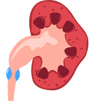Ureteral Obstruction